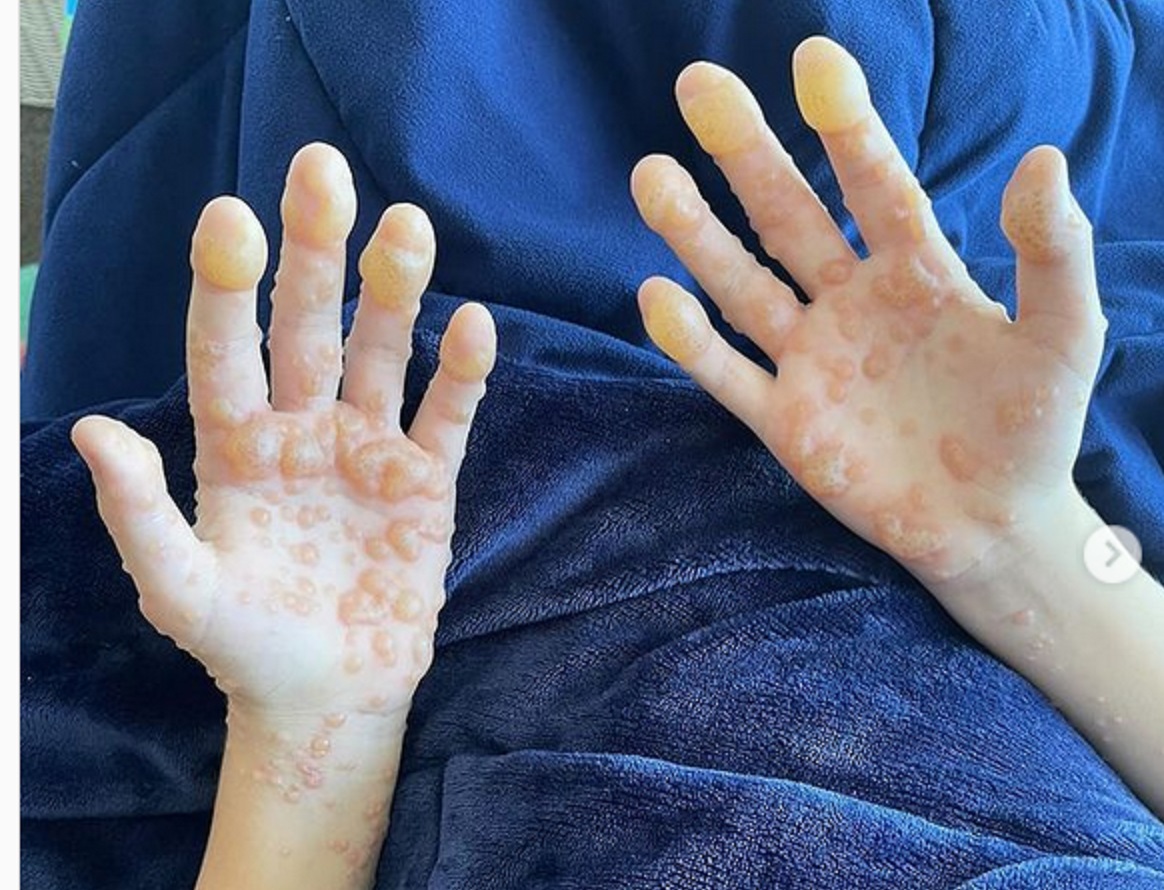 Vaccin, Război, Moarte - Rețeta Marii Restetări. Unde sunt fotografiile cu mortala monkeypox? Variola maimuței sau reacții adverse la vaccinul Covid? Cititorii ActiveNews sunt mai inteligenți decât „marii resetori” | ActiveNews