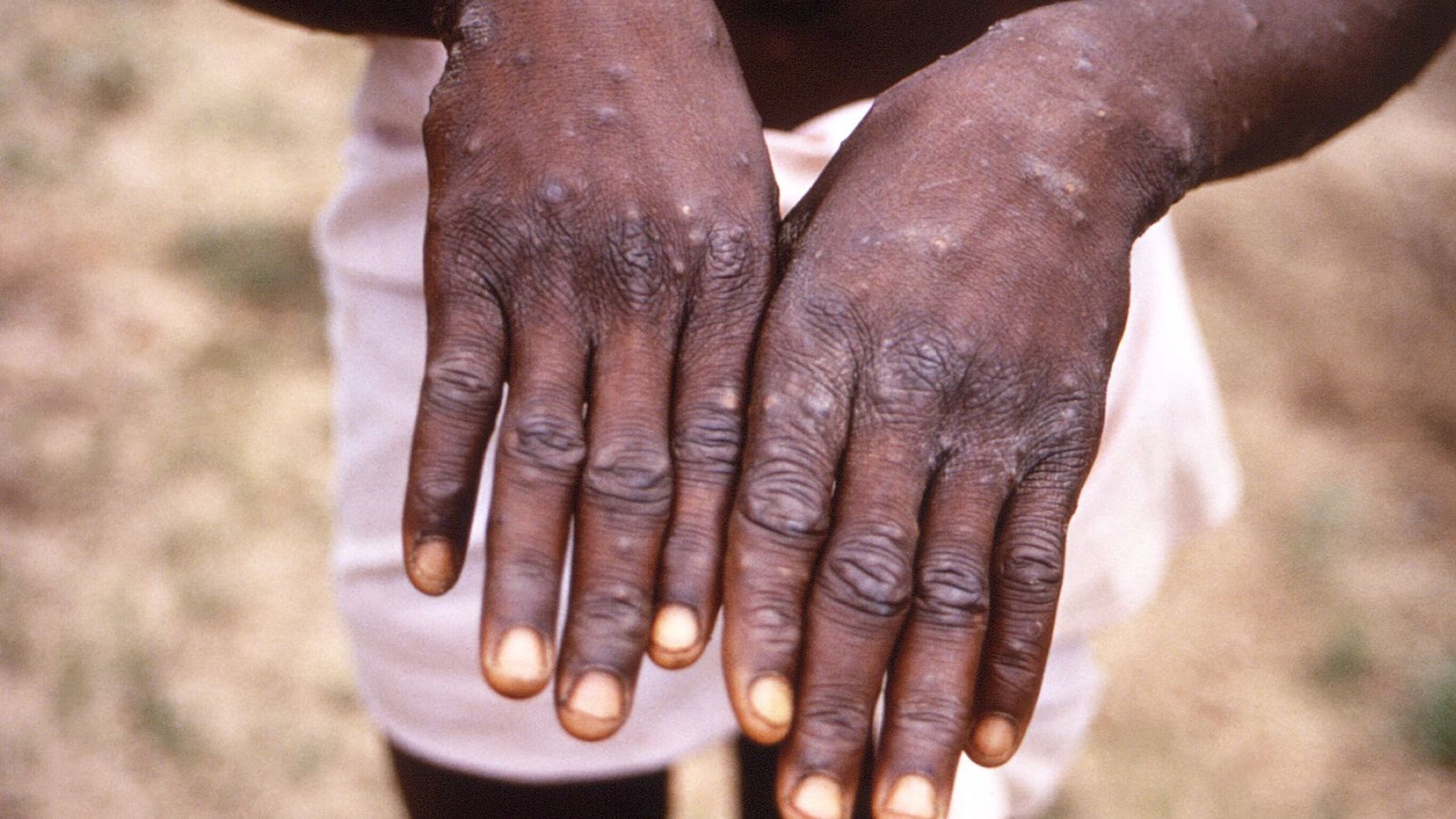 UK set to announce more monkeypox cases as high-risk close contacts told to isolate for three weeks - SoucialNews.com