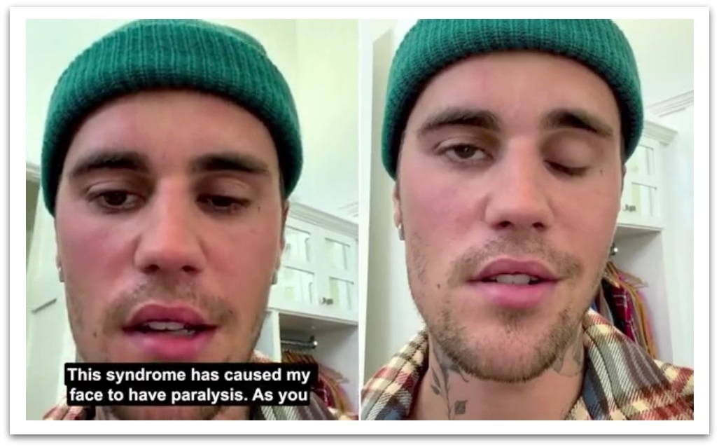 Justin Bieber are paralizie facială. Sigur nu e de la vaccin! Soția lui, Hailey Bieber, de 25 de ani, a avut recent un accident vascular cerebral din cauza unui cheag de sânge de prin zona posibilului creier | ActiveNews