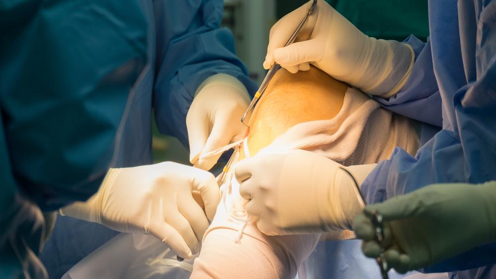 The Ultimate Guide to Ligament Reconstruction Surgery: What to Expect | TechPlanet