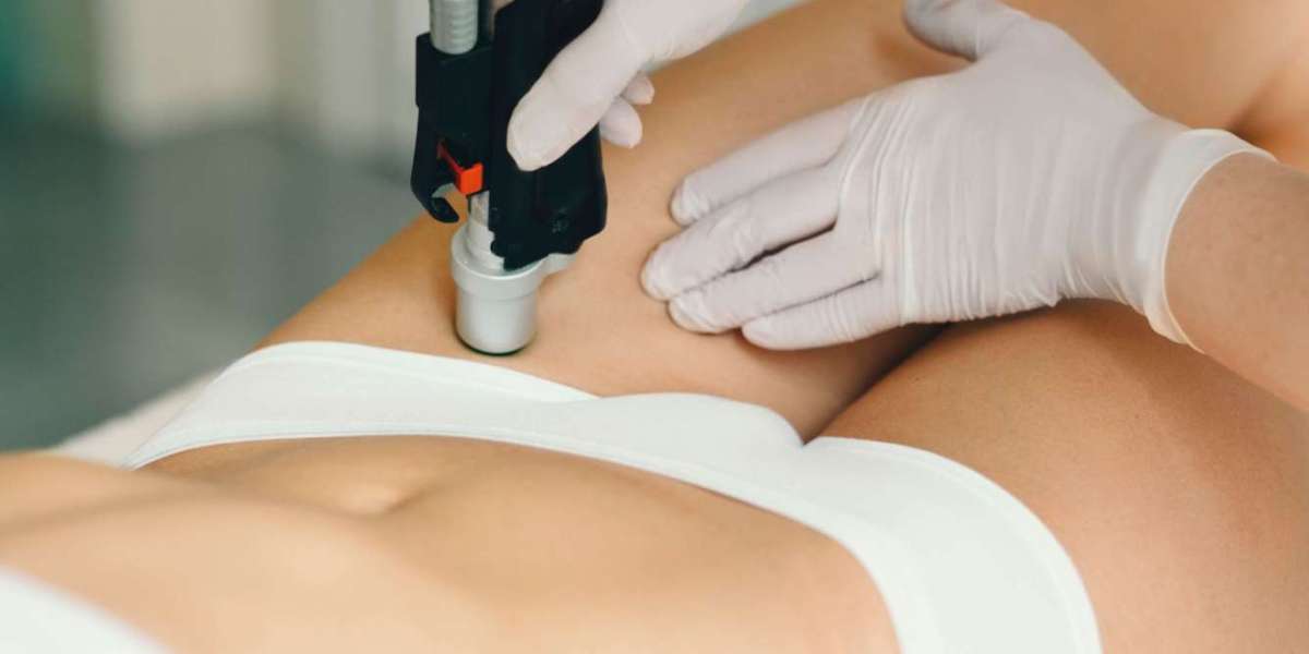 Bikini Laser Hair Removal: What to Expect from Start to Finish