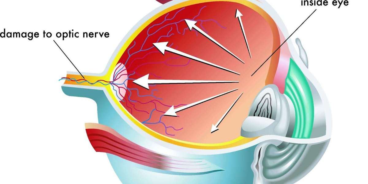 Cataract Eye Surgery Cost Brisbane | How Long Does Cataract Surgery Take