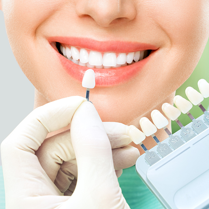 Best Dental Veneers Abu Dhabi | Dental Veneers in Abu Dhabi