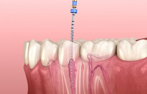 Root Canal in Abu Dhabi | Best Root Canal Treatment