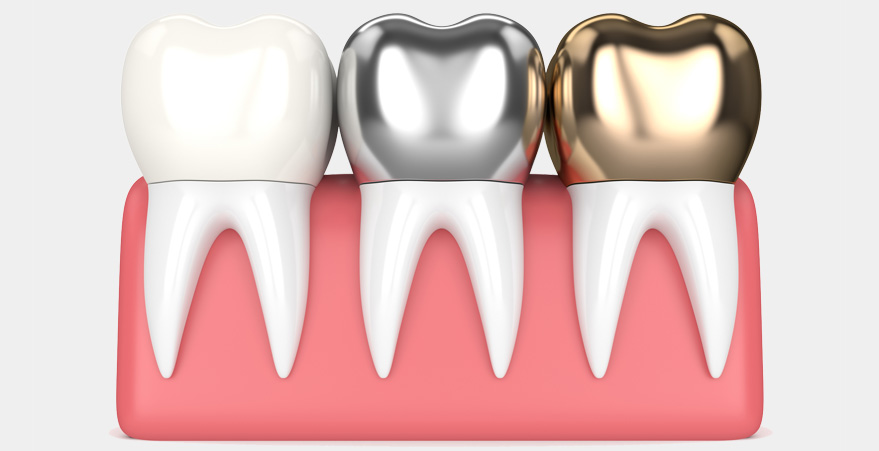 Dental Crown Cost in Abu Dhabi | Dental Crown Treatment