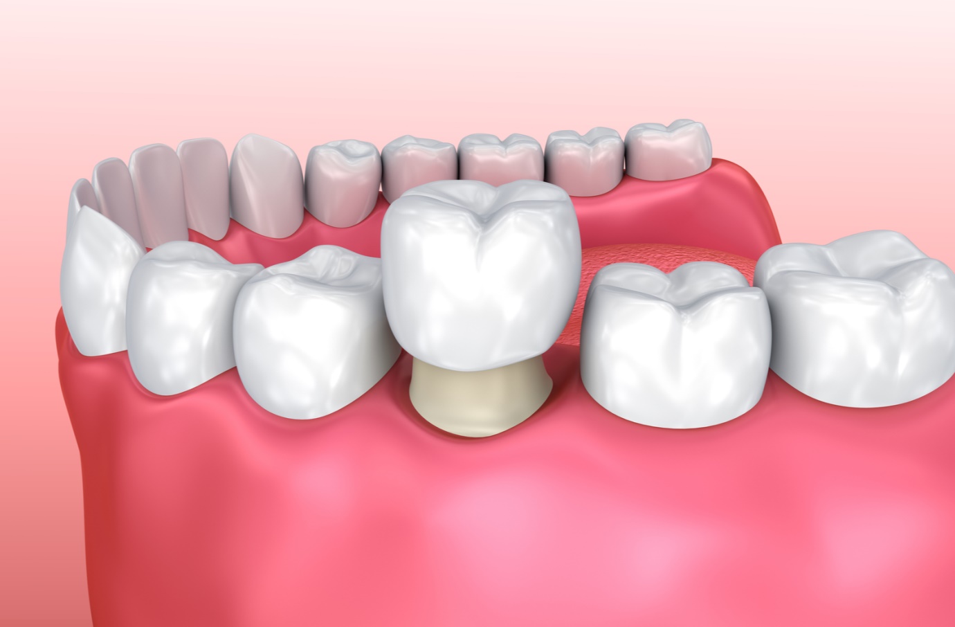 The Role of Dental Crowns in Restoring Chipped or Damaged Teeth