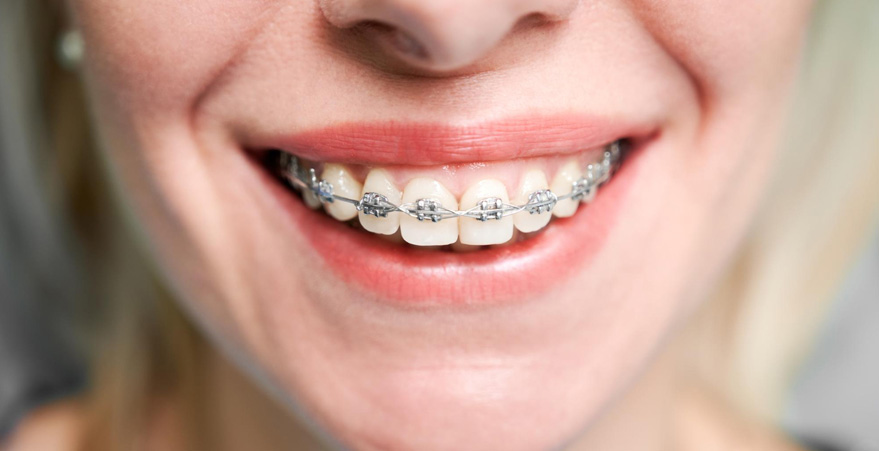 Dental Braces in Abu Dhabi | Advanced Dental Braces