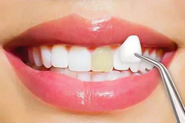 The Cost of Dental Veneers: Factors That Affect Affordability