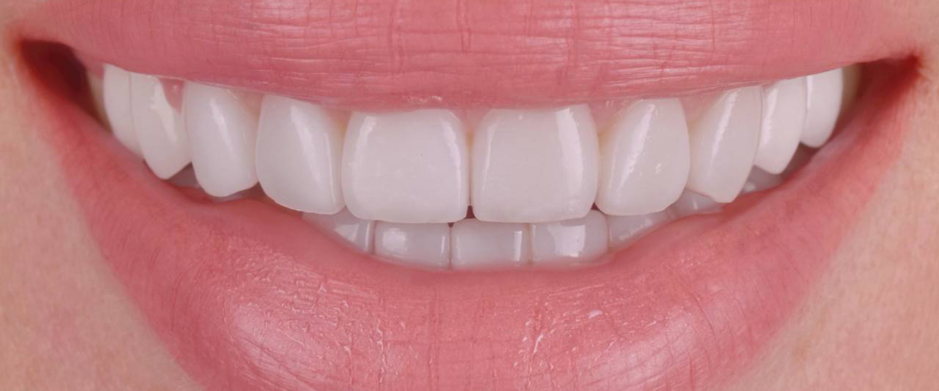 Dental Veneers in JLT Dubai | Luxury Smile Makeover