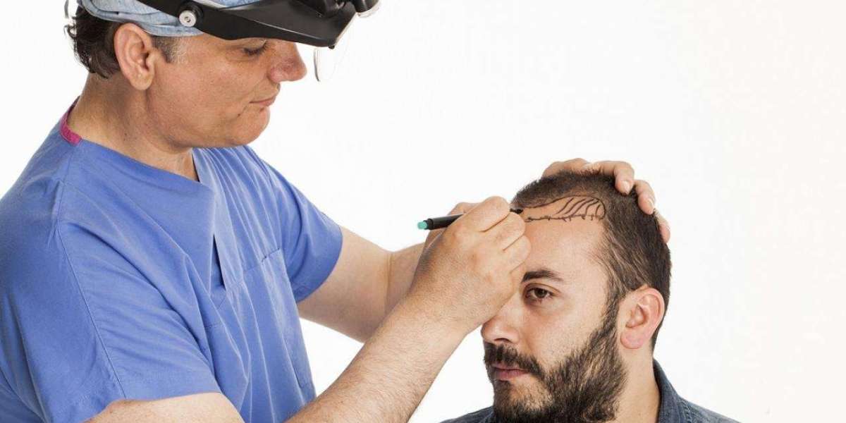 The Role of PRP Therapy with Hair Transplant in Islamabad