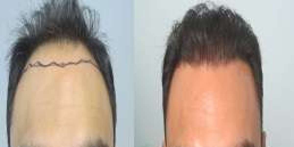 FUE vs. FUT Hair Transplant in Dubai – Which is Right for You?