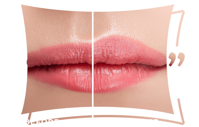 Botox Lip Flip in Dubai & Abu Dhabi | Lip Flip Price & Cost