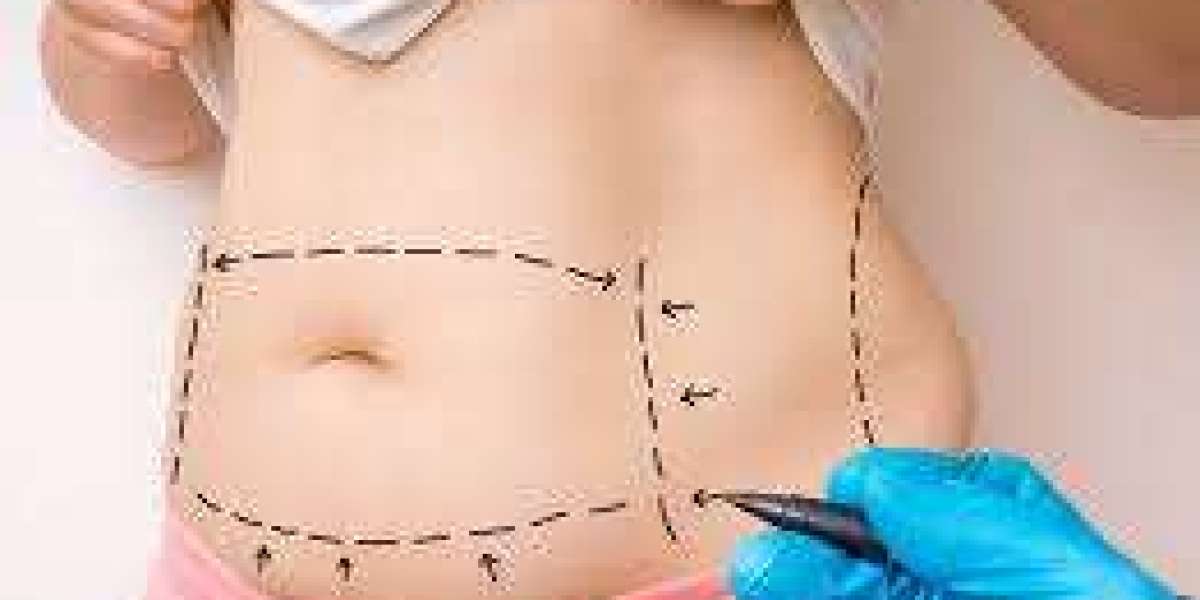 How Long Does It Take to Recover from a Tummy Tuck in Dubai?