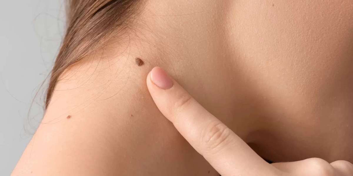 How to Care for Skin After Mole Removal Procedures