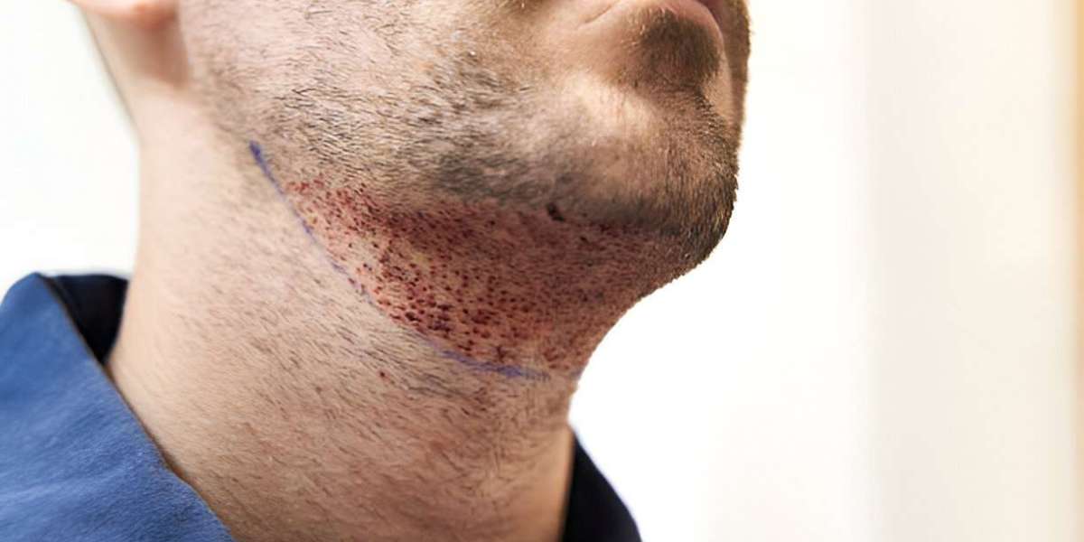 How a Beard Transplant Can Restore Confidence and Transform Your Look