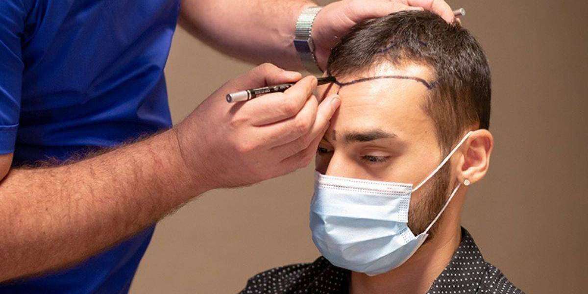 Can Insurance Cover Hair Transplant in Islamabad?