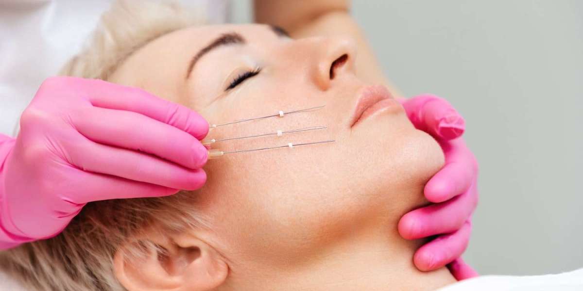 Thread Lift for Double Chin: Is It Effective?