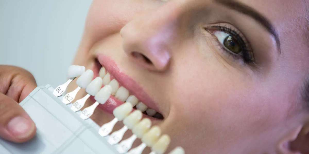 Non-Prep Veneers vs. Whitening Treatments: Which Lasts Longer?