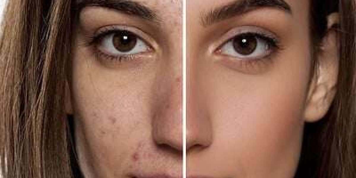 Honey and Turmeric for Acne: Myth or Miracle?
