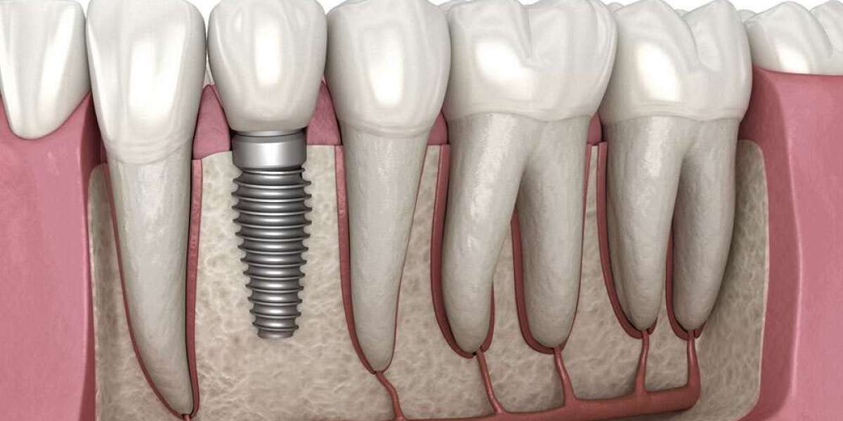 How Dental Implants Help Preserve Facial Structure