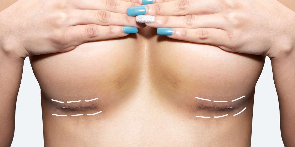 Is a Breast Lift Right for You? Factors to Consider Before Surgery
