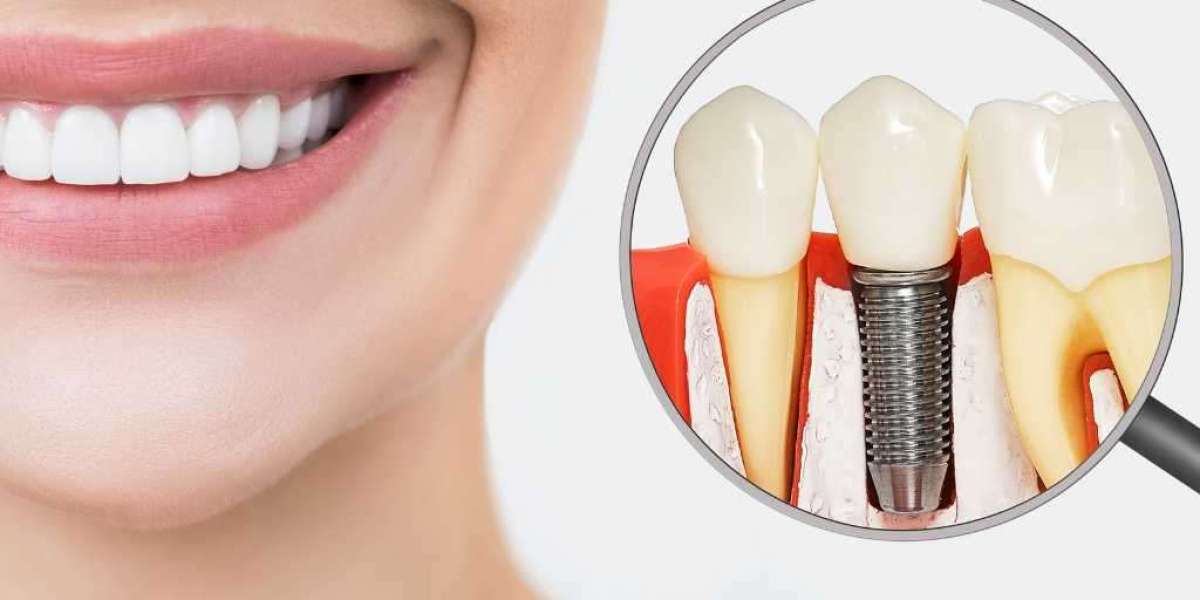 What Makes Same-Day Dental Implants Different from Dentures?