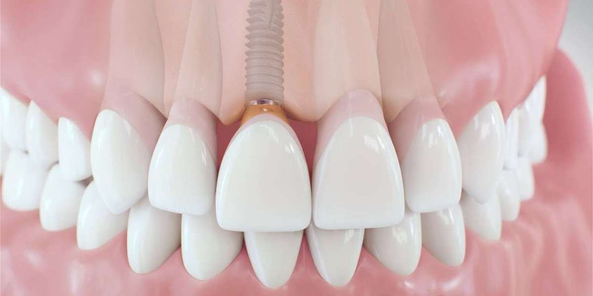 What Is Peri-Implantitis and How Can It Lead to Infection?