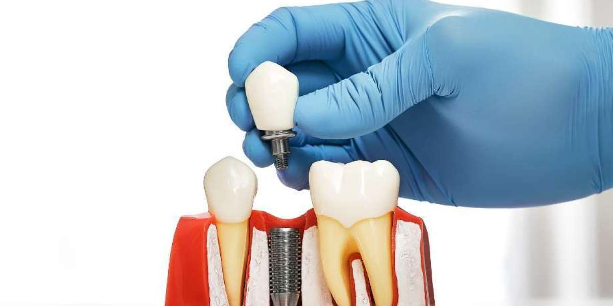 Do Same-Day Dental Implants Hurt? What to Expect