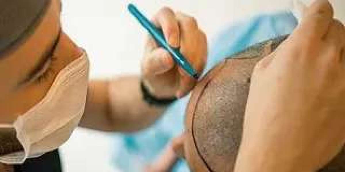 The Evolution of Hair Transplant Methods in Islamabad Over the Last Decade