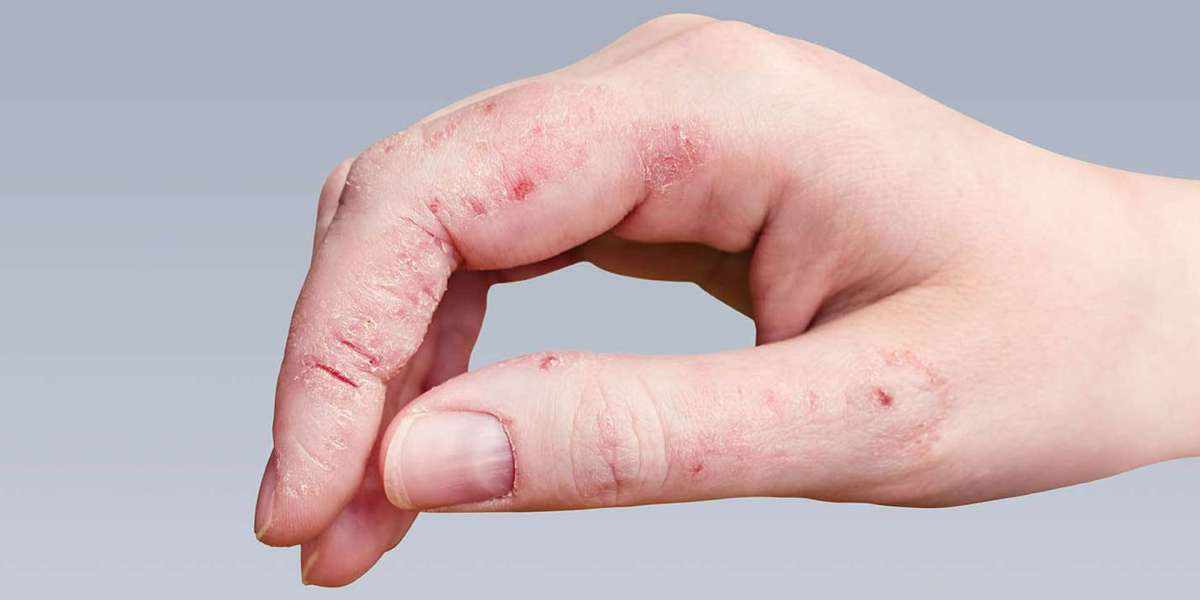 The Hidden Triggers Behind Chronic Skin Disorders