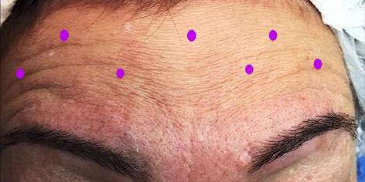 Mikro- vs. traditionelles Botox: Warum Babytoxin die ästhetischen Trends übernimmt