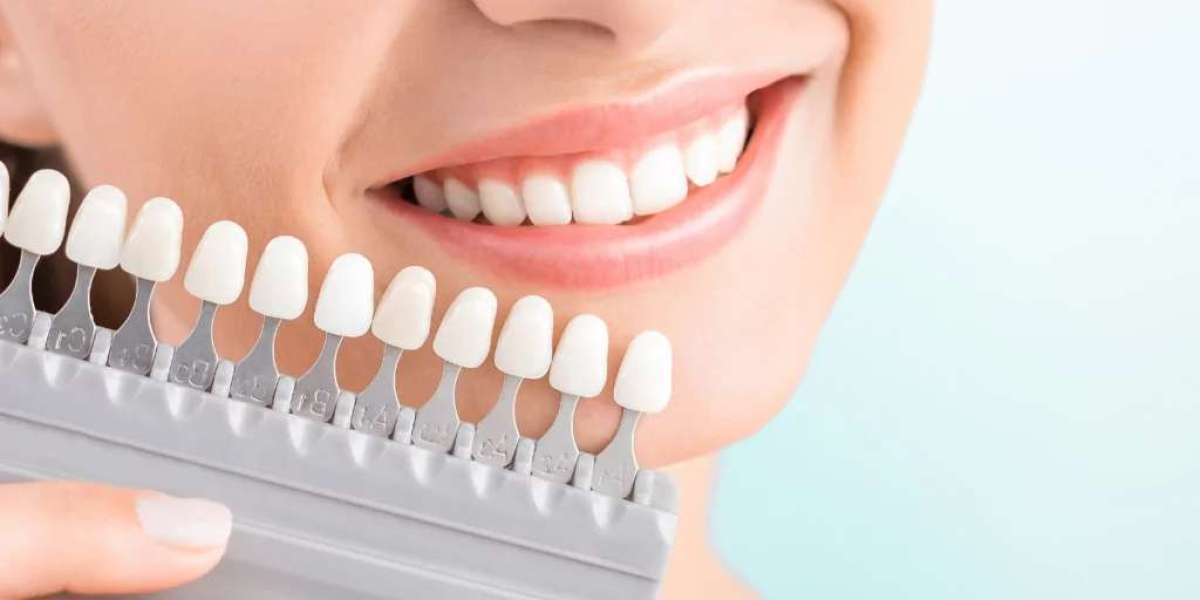 How E-max Veneers Can Boost Your Confidence