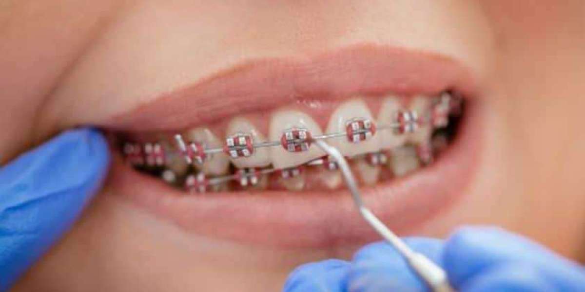 Eating With Braces: What to Avoid and What’s Safe