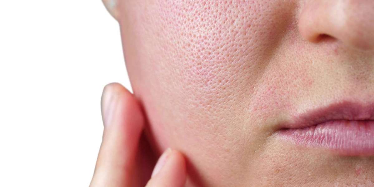 The Ultimate Guide to Large Pores Treatment for Oily Skin