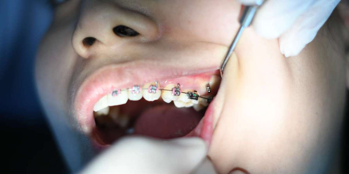 The Most Common Orthodontic Myths: Fact vs. Fiction