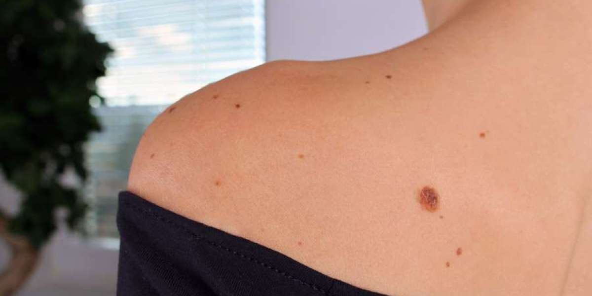 Types of Moles and How to Identify Them