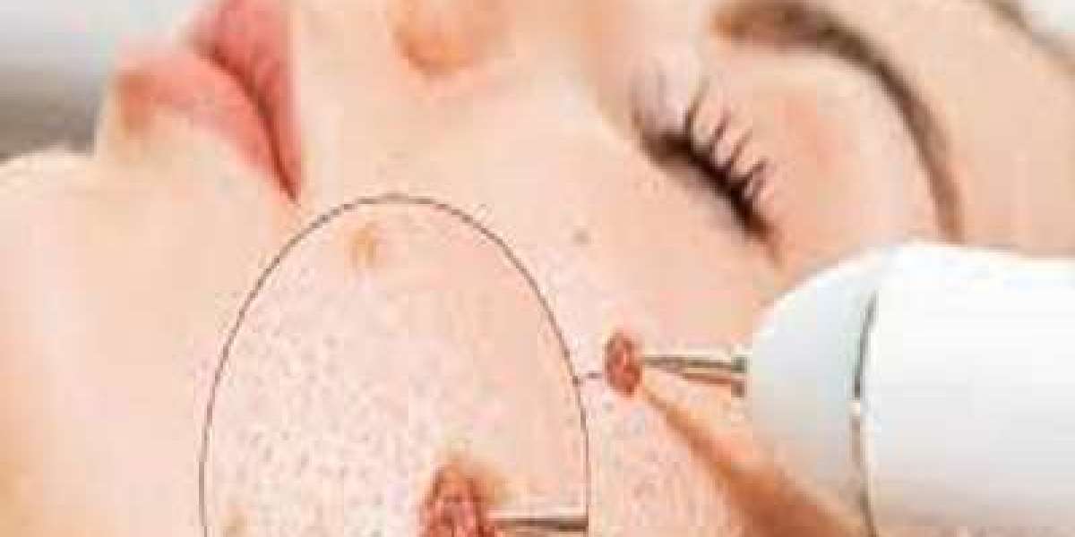 Wart Removal for Kids: Safe Options for Children