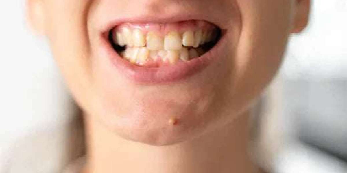 How Crooked Teeth Affect Your Confidence and How Treatment Can Help