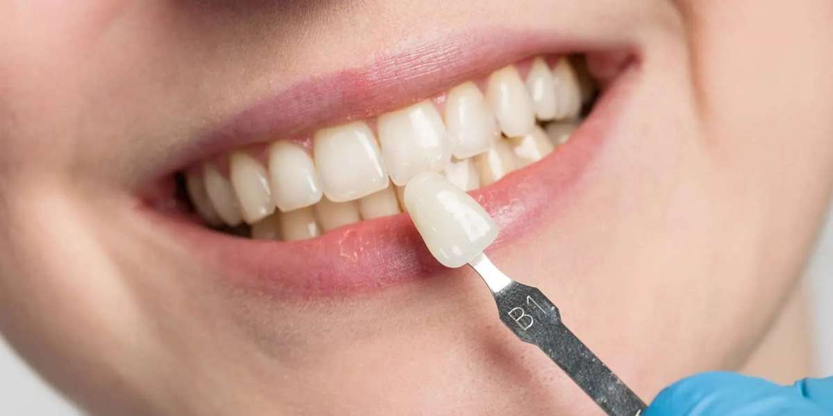 What to Expect at Your First Non-Prep Veneer Consultation
