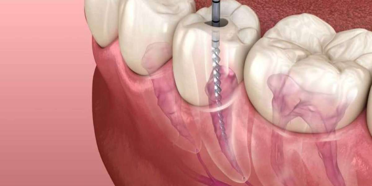 Root Canal vs. Replacing a Tooth: Pros and Cons Explained