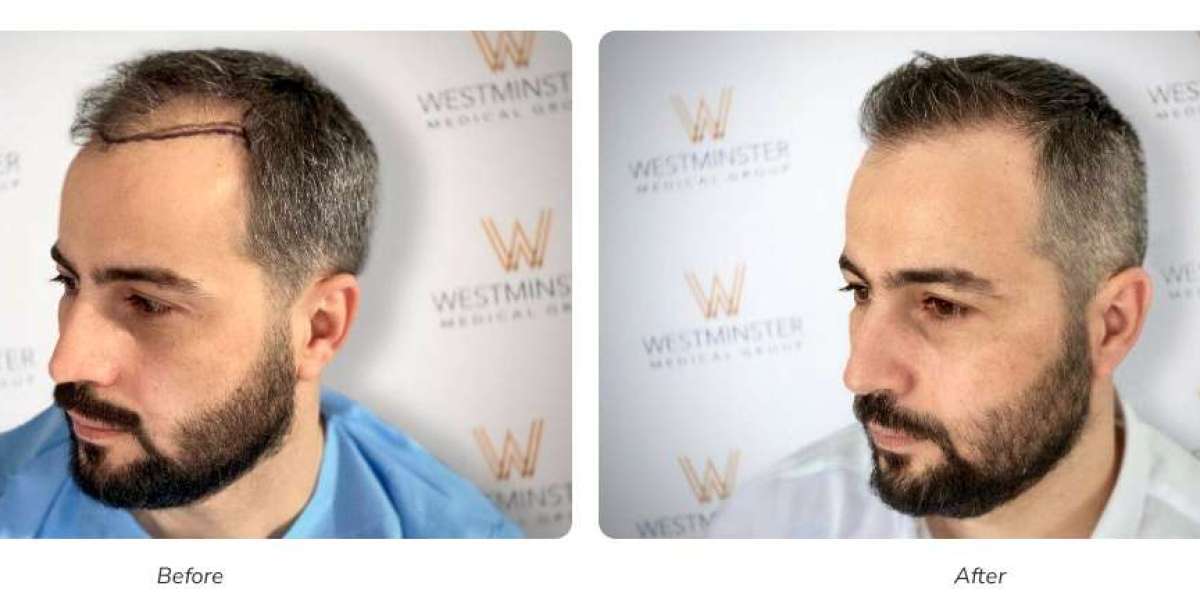 Hair Transplant London – Your Guide to Restoring Hair Naturally