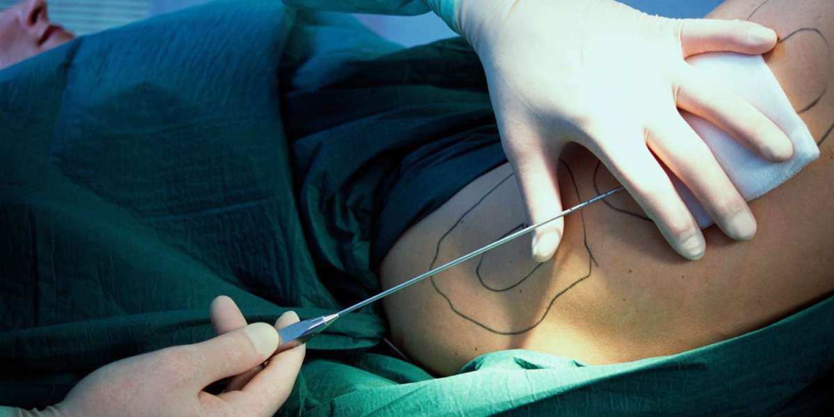 Back Liposuction in Islamabad: Reduce Love Handles and Bra Bulge