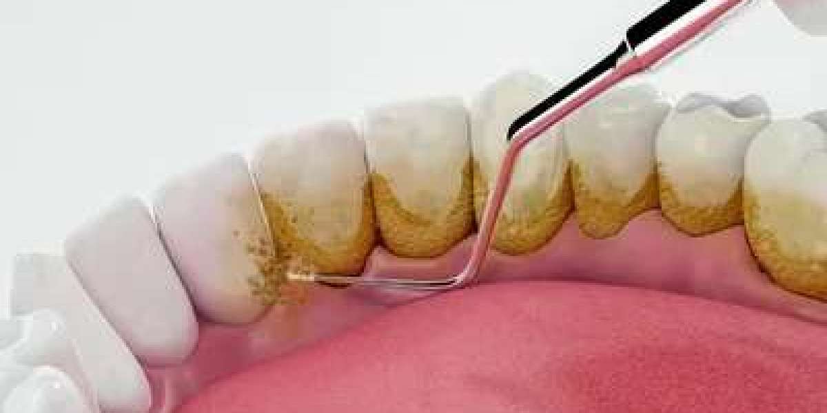 Teeth Scaling in Islamabad: Building a Culture of Preventive Dental Care