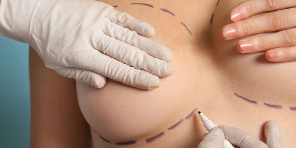 Is a Breast Lift Right for You? Signs to Consider