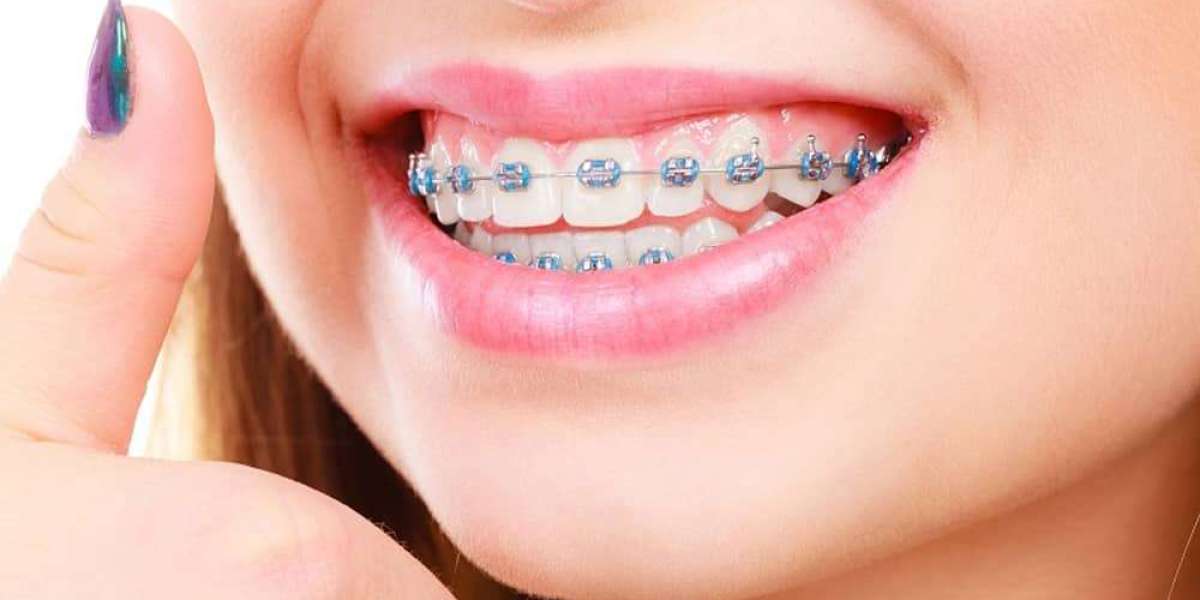 Discreet Orthodontic Options for Working Professionals