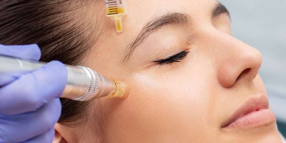 How PRP Hair Therapy is Revolutionizing Hair Restoration