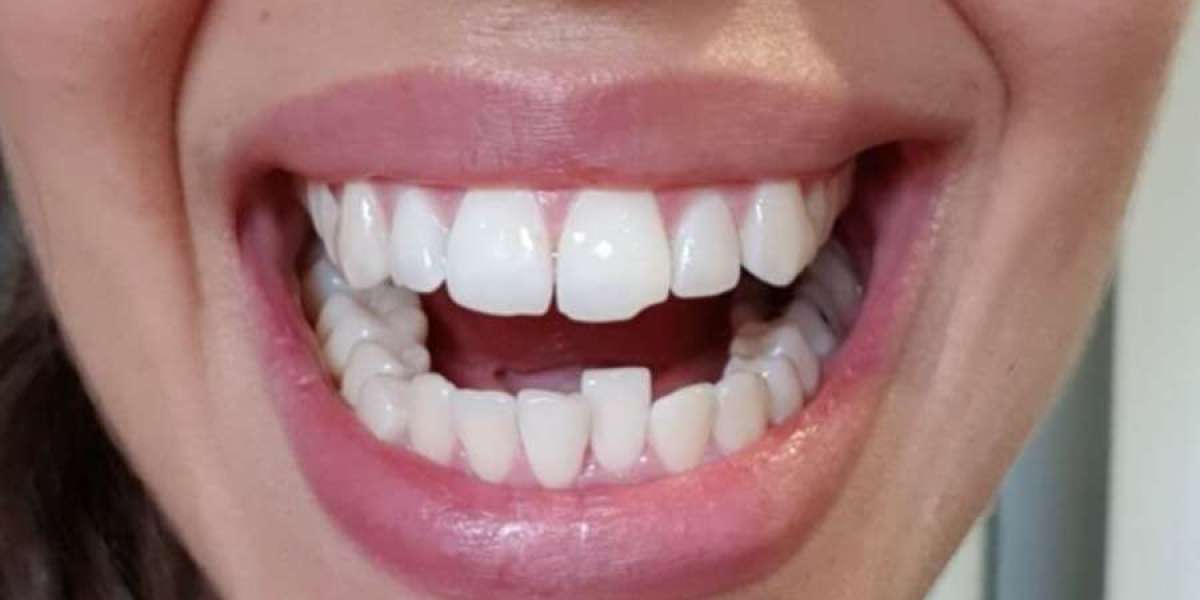 What to Expect During Your Journey to Straighter Teeth