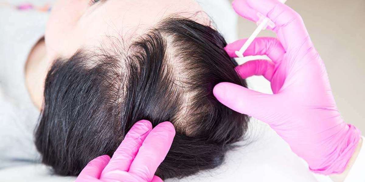 How PRP Hair Restoration Works: A Step-by-Step Guide