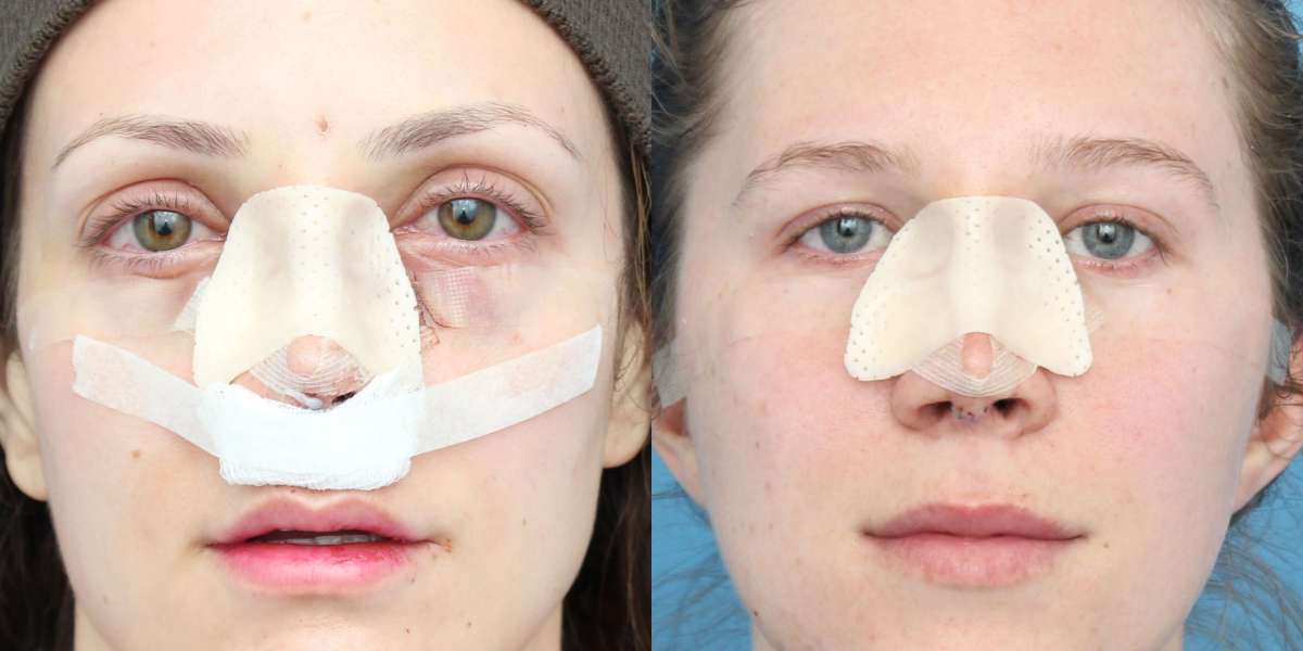 What Are the Most Common Complications with Rhinoplasty in Dubai?