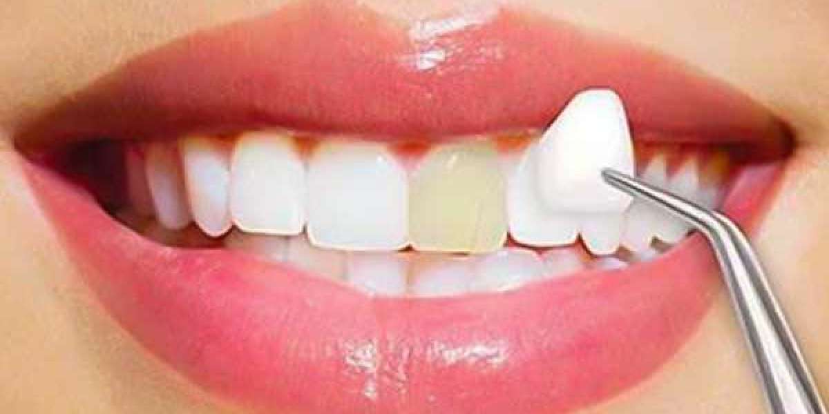 Can Veneers in Dubai Make Your Smile Look Too Perfect or Unnatural?